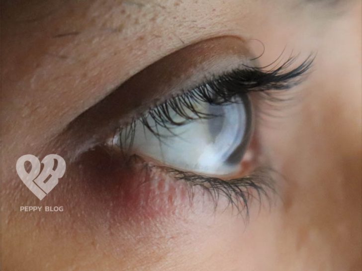How To Get Rid Of A Stye (Eye Pimple) 3 Home Remedies Peppy Blog